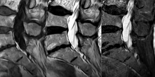 radiculographie lucchérini infiltration